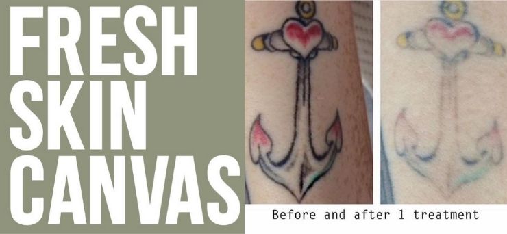 Fresh Skin Canvas Tattoo Removal Melbourne - Melbourne Region - VIC | OBZ -  Online Business Zone